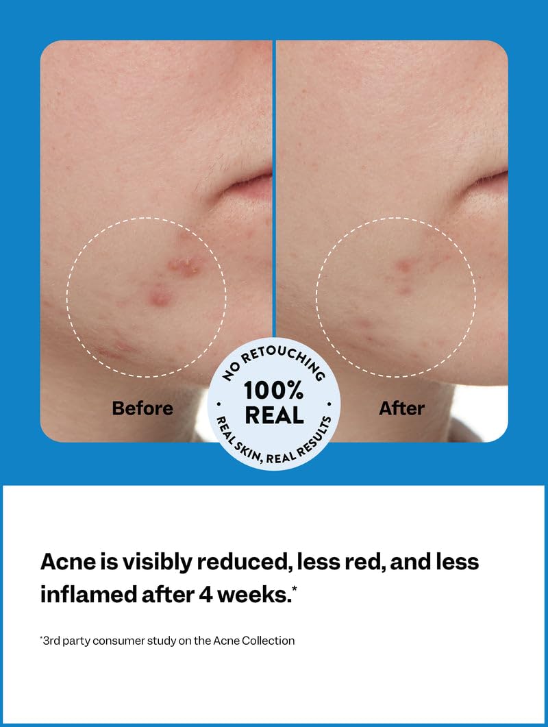 PEACH SLICE 3-Step Acne Starter Kit