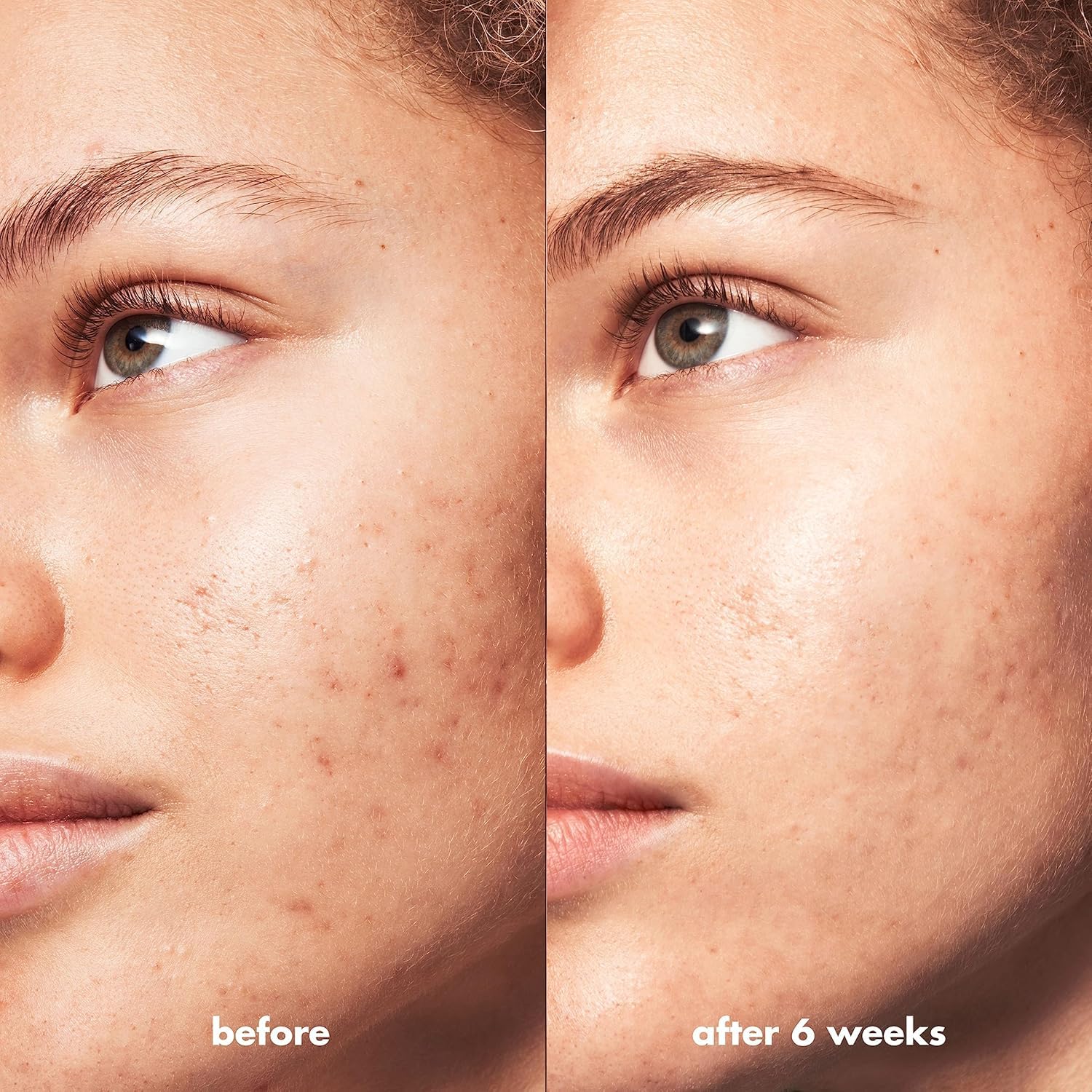 e.l.f SKIN Blemish Breakthrough Triple-Acid Resurfacing Serum