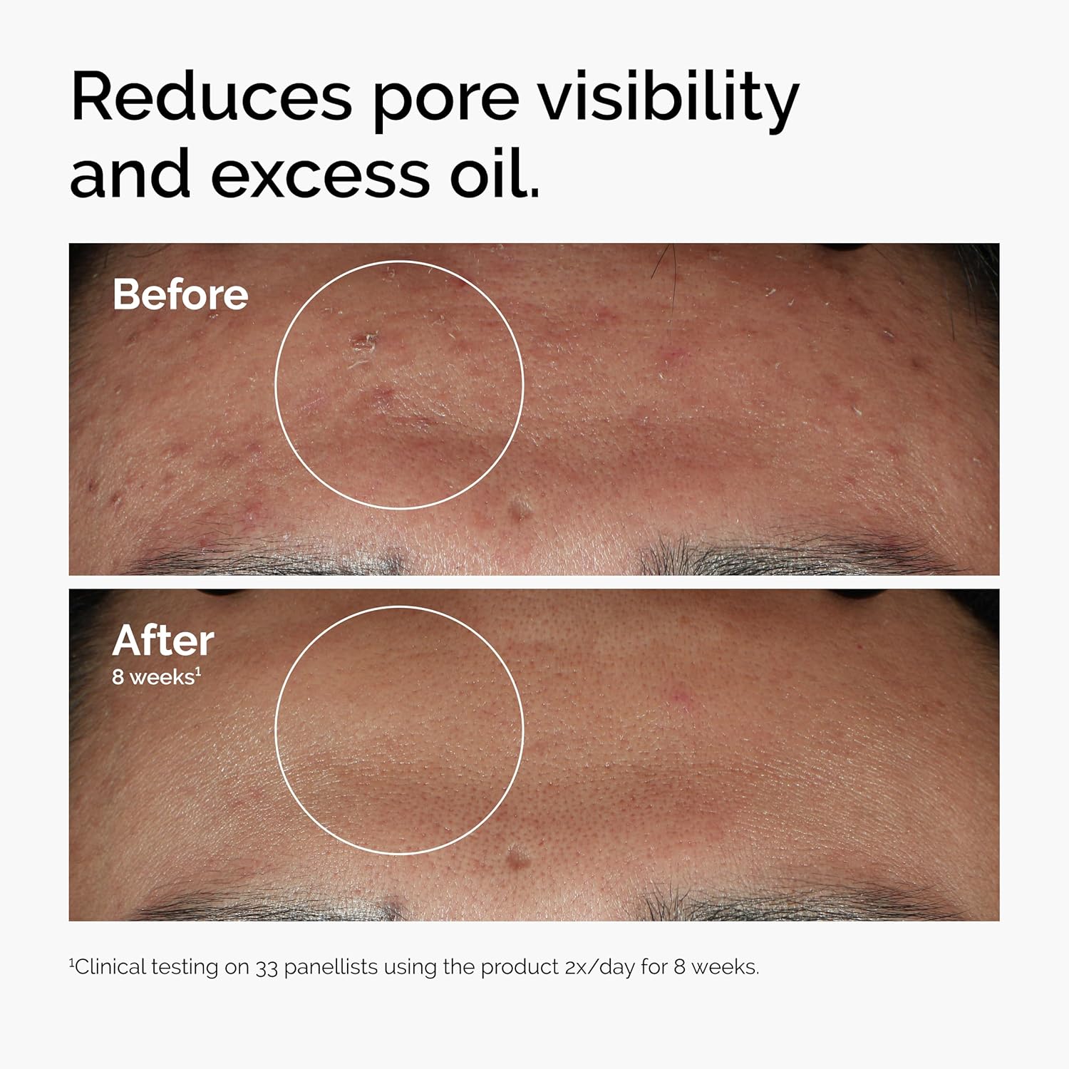 THE ORDINARY High-Strength & Blemish Serum