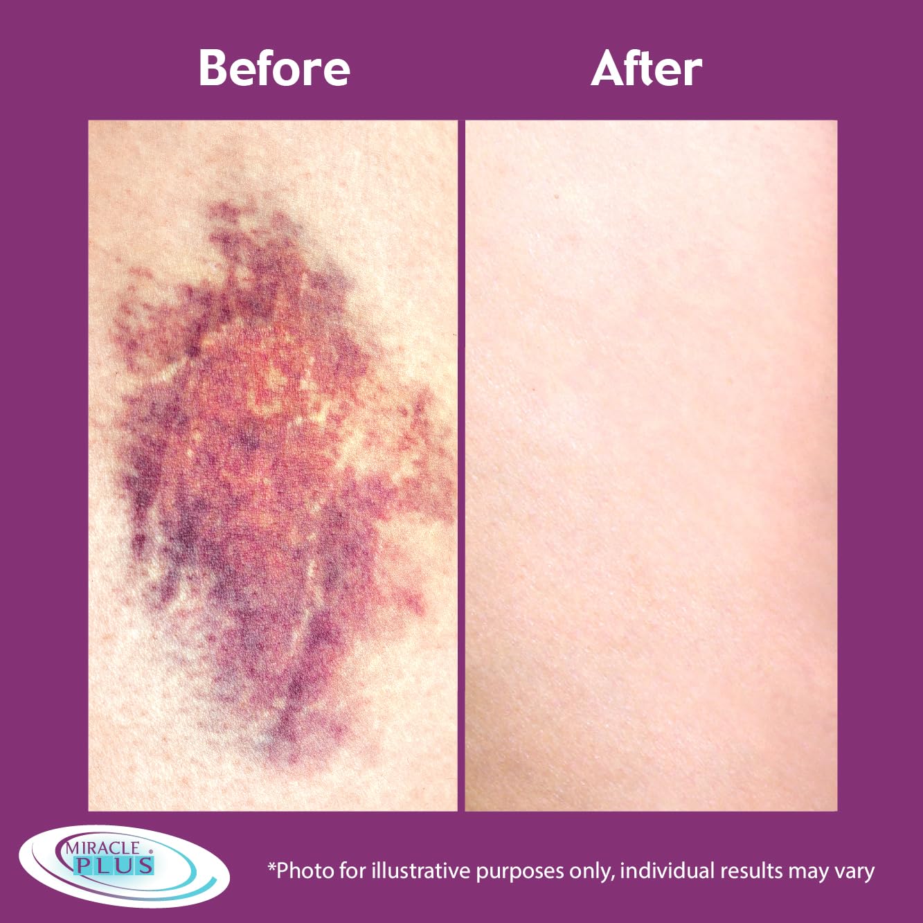 MIRACLE Plus Arnica Bruise Cream