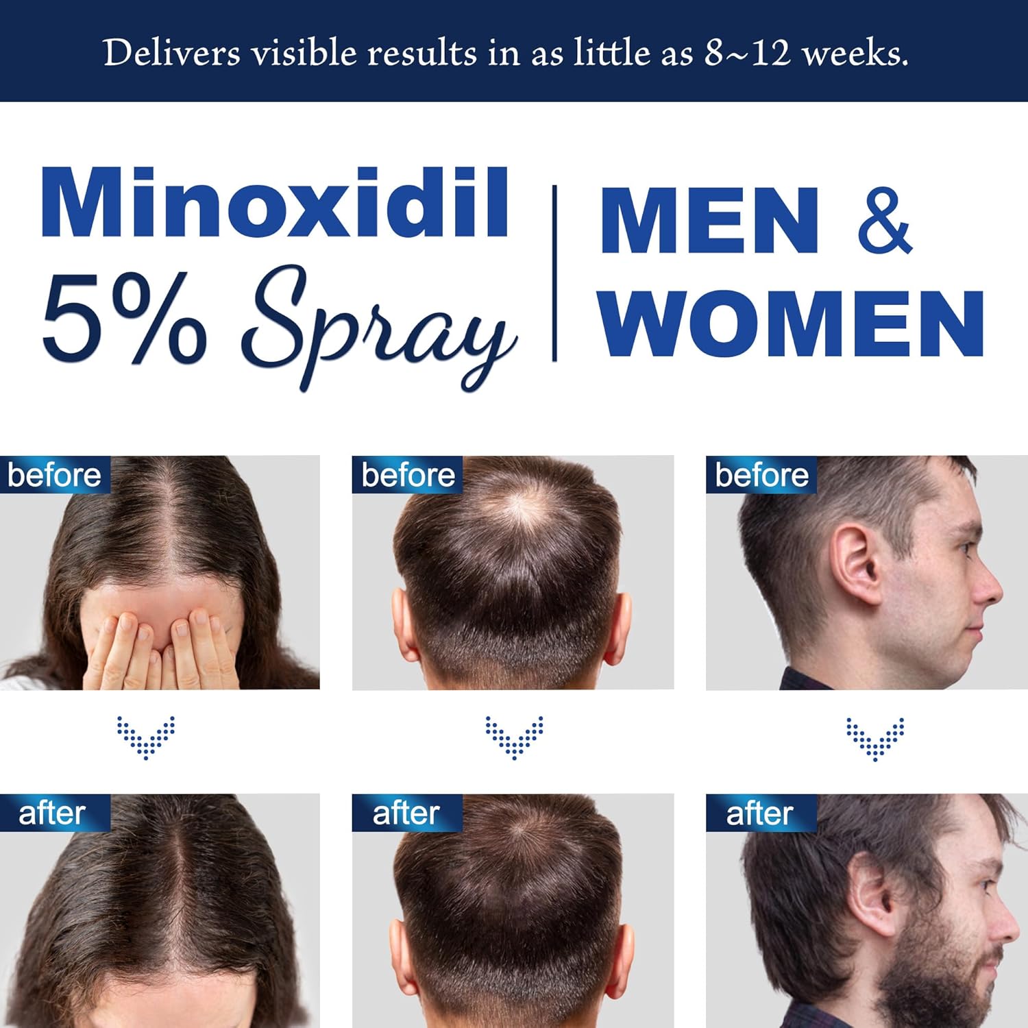 OSIMOON Minoxidil Spray With Biotin Hair Growth Serum