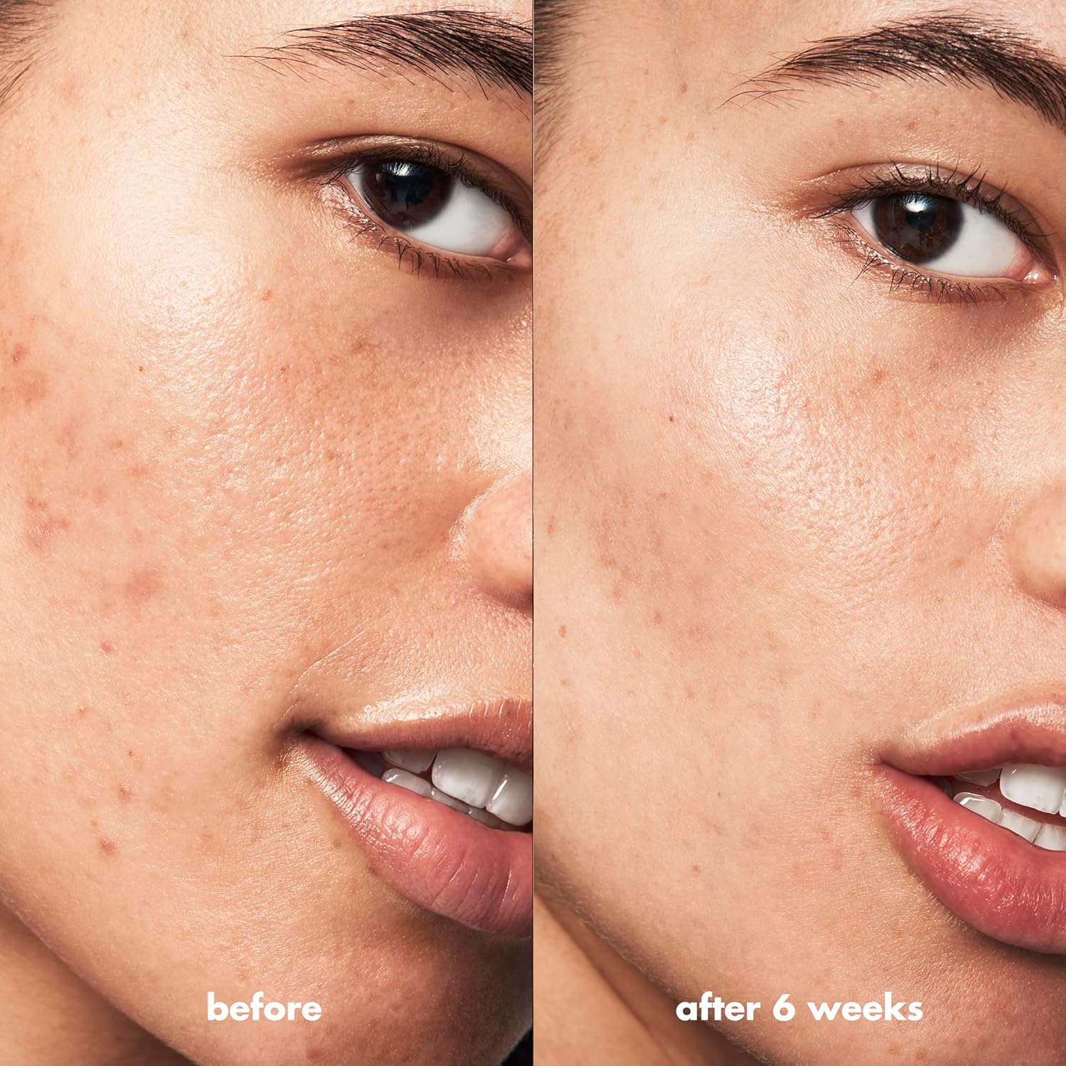 e.l.f SKIN Blemish Breakthrough Acne Fighting Spot Gel